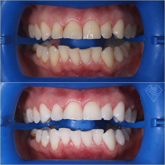 Стоматология Самара Мед отбеливание зубов и ультразвуковая чистка результат работы