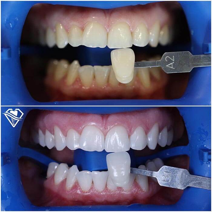 Стоматология Самара Мед отбеливание зубов и ультразвуковая чистка результат работы