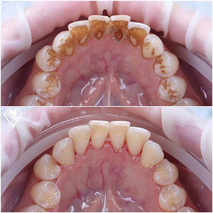 Стоматология Самара Мед ультразвуковая чистка зубов результат работы