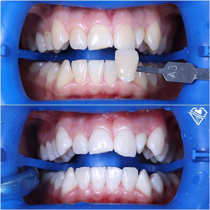 Стоматология Самара Мед отбеливание ZOOM white speed и ультразвуковая чистка зубов результат работы