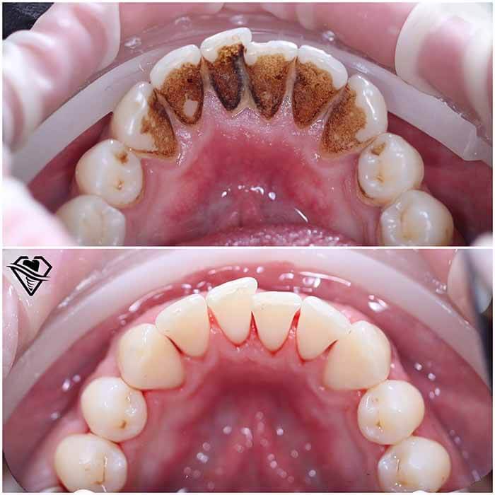 Стоматология Самара Мед ультразвуковая чистка зубов результат работы
