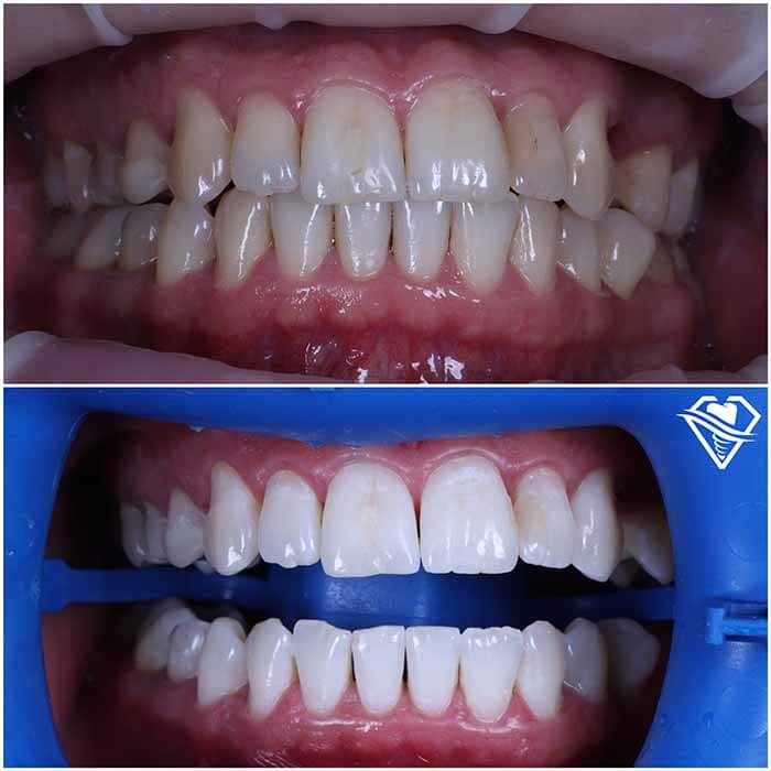 Стоматология Самара Мед отбеливание ZOOM white speed и ультразвуковая чистка зубов результат работы