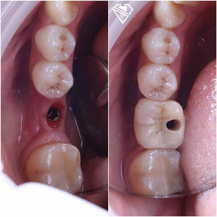 Стоматология Самара Мед имплантация зубов результат работы