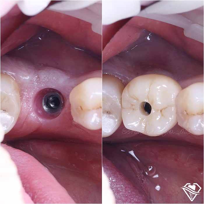Стоматология Самара Мед имплантация зубов результат работы