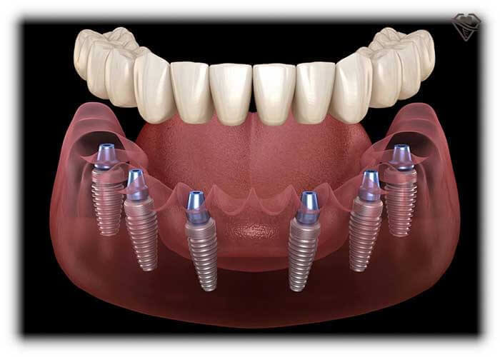 Полное протезирование на 6 имплантах All-on-6 в стоматологии Самара Мед, фото