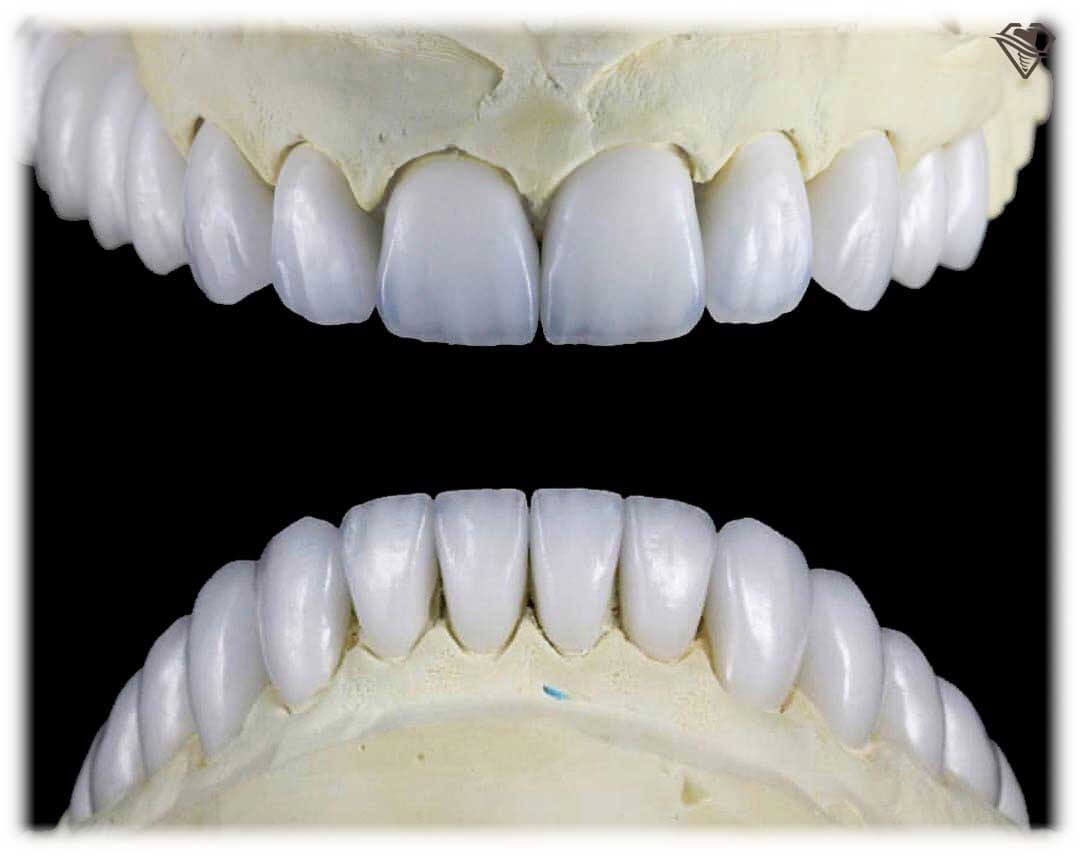 Цельнокерамическая коронка E-Max за 13.000 рублей в стоматологии Самара Мед, фото