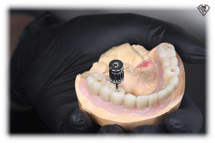 Имплантация зубов под ключ за 31.990 рублей в стоматологии Самара Мед, фото