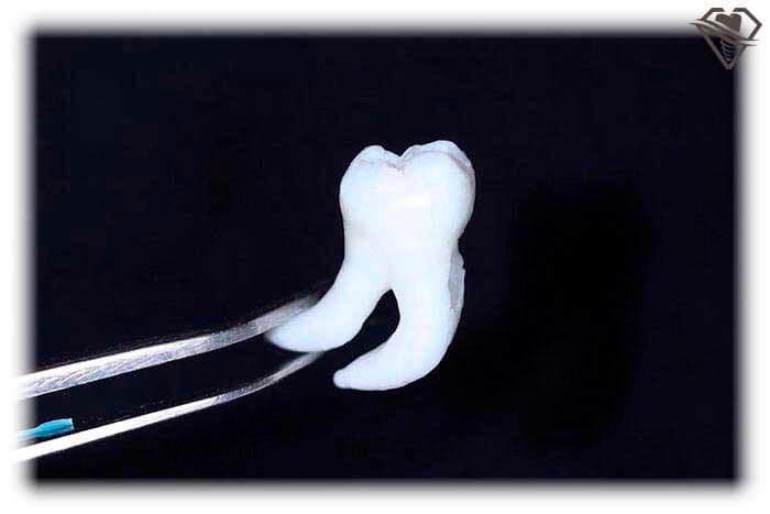 Удаление зуба от 2.200 рублей в стоматологии Самара Мед, фото