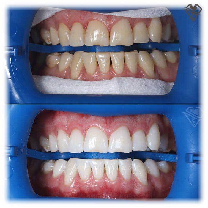 Отбеливание зубов Philips Zoom! WhiteSpeed 15.000 рублей в стоматологии Самара Мед, фото