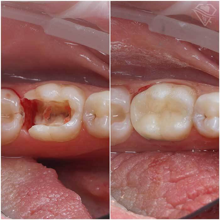 Стоматология Самара Мед лечение пульпита и восстановление зуба