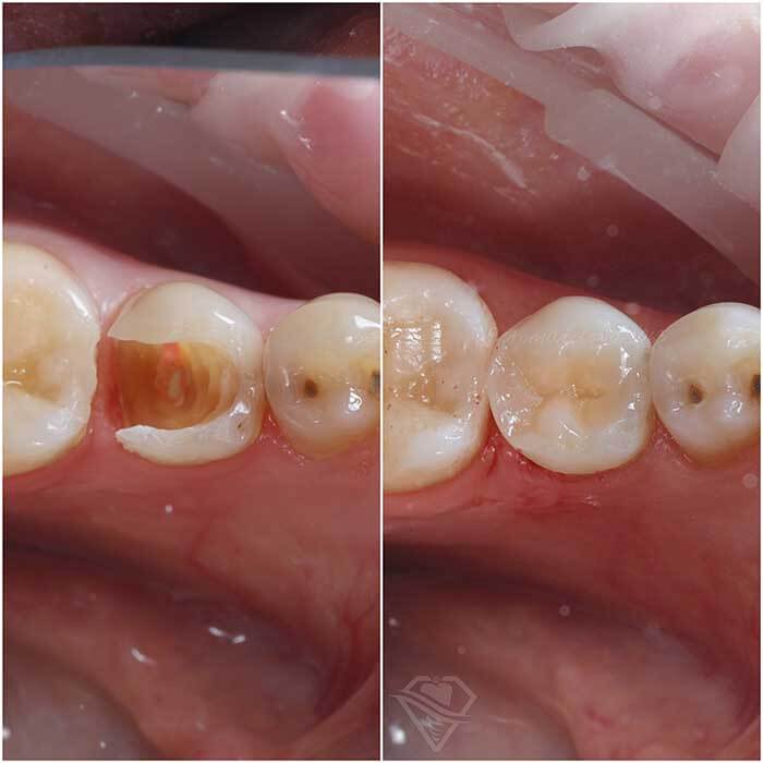 Стоматология Самара Мед лечение пульпита и восстановление зуба