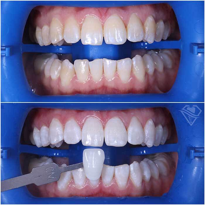 Стоматология Самара Мед профессиональная чистка и отбеливание зубов