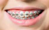 metall_gotovo Металлические брекеты фото